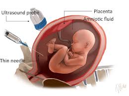 Chromosomal (genetic make up of the baby) Screening in Pregnancy